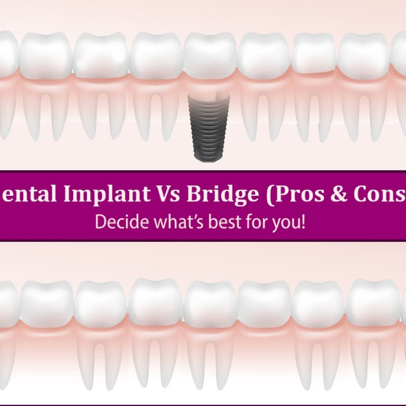 Latest Innovations In The Dental Implant Technology