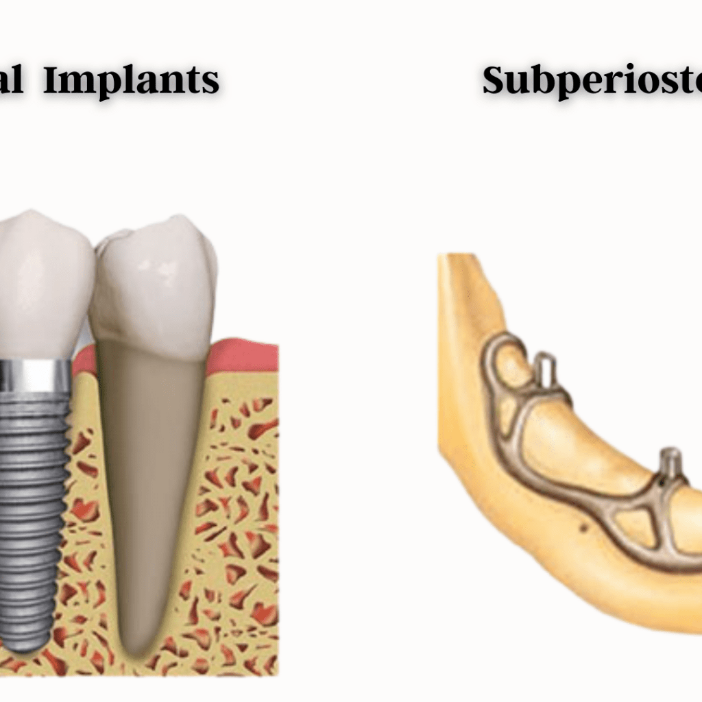 Let S Learn About The Nitty Gritty Of Dental Implants