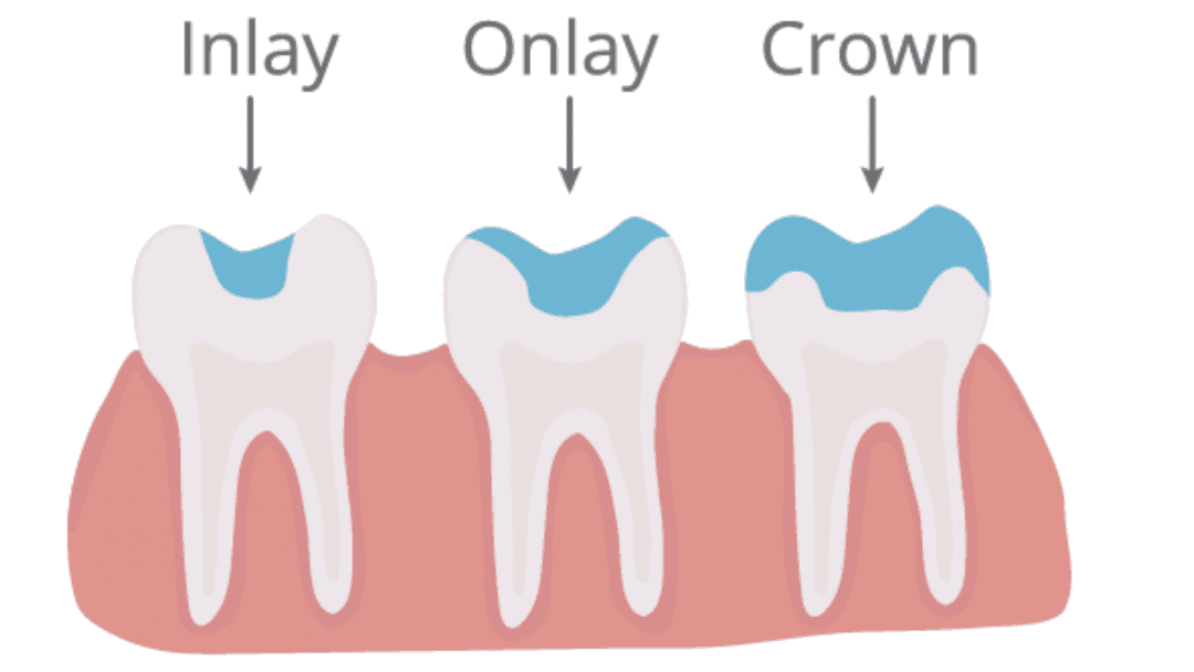 Whats The Difference Between Onlay And Crown