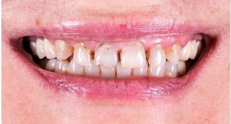 braces cheap brisbane | adult braces cost brisbane