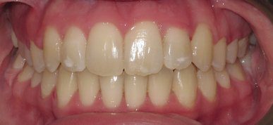 INVISALIGN - DENTIST IN BRISBANE