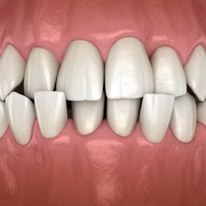 Crossbite Teeth Treatment