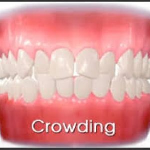 Crowding - My Gentle Dentist