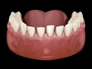 Excessive Spacing Teeth Treatment -