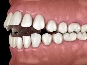 Open Bite Treatment - My Gentle Dentist @ Arana Hills and @ Brookside