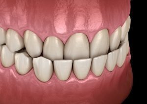 Underbite - My Gentle Dentist