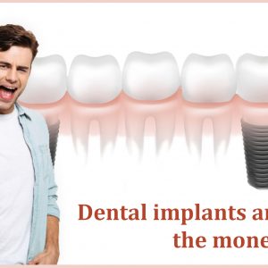 Read more about the article Dental Implants are Worth the Money Spent