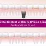 Read more about the article Dental Implants Vs Dental Bridges (Pros & Cons): Decide what’s best for you!