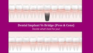 Dental Implants Vs Dental Bridges (Pros & Cons): Decide what’s best for you!
