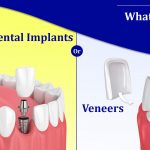 Read more about the article Dental Implants or Veneers (Pros & Cons): What’s better for you!