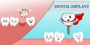 Top 5 Benefits of Dental Implants