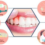 Read more about the article Gingivitis: Gum Disease Treatment, Symptoms, and Prevention