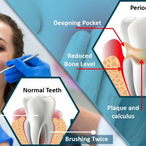 Read more about the article Periodontitis: Gum Disease Symptoms, Treatment, and Prevention