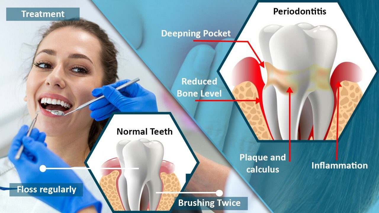 You are currently viewing Periodontitis: Gum Disease Symptoms, Treatment, and Prevention