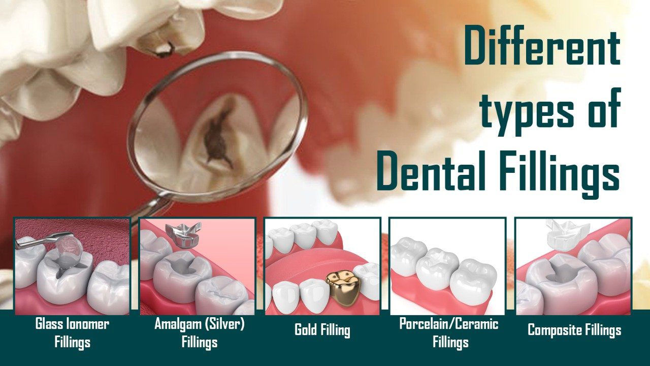 You are currently viewing What are the Different Types of Dental Fillings?
