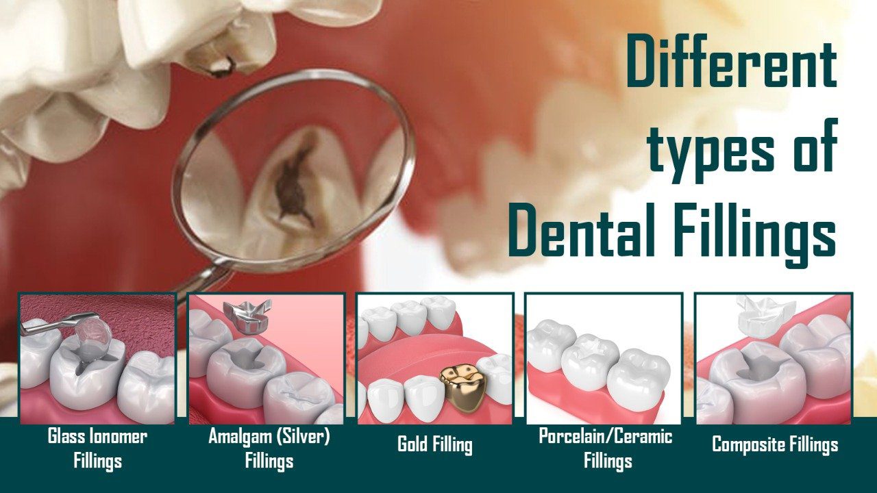 What Are The Different Types Of Dental Fillings My Gentle Dentist