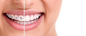 How to Boost your Confidence with Invisalign as an Aspiring Model?