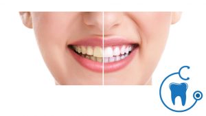 What Are The Advantages of Teeth Whitening?