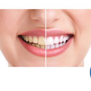 Read more about the article What Are The Advantages of Teeth Whitening?