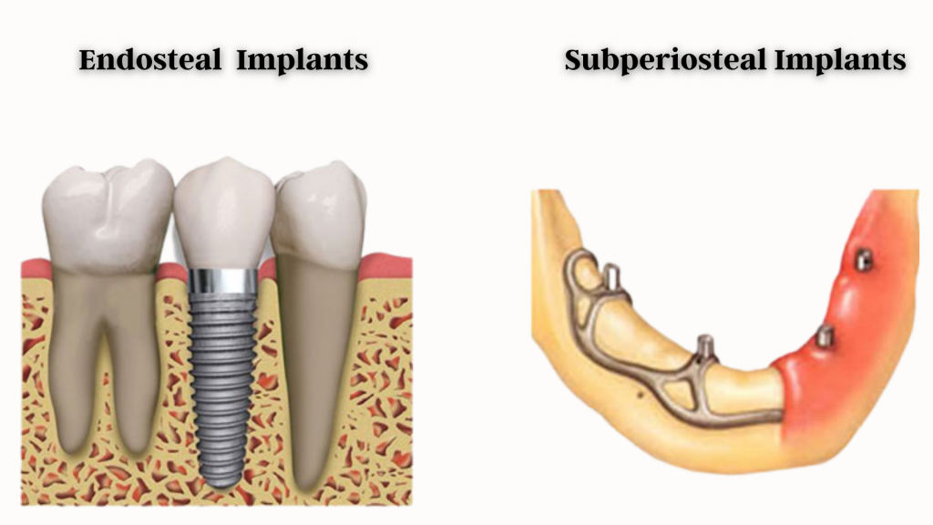 Endosteal Subperiosteal Implants - Dental Implant Dentist