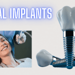 Read more about the article Let’s Learn About The Nitty-Gritty Of Dental Implants!