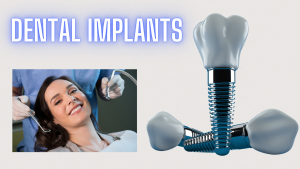 Let’s Learn About The Nitty-Gritty Of Dental Implants!