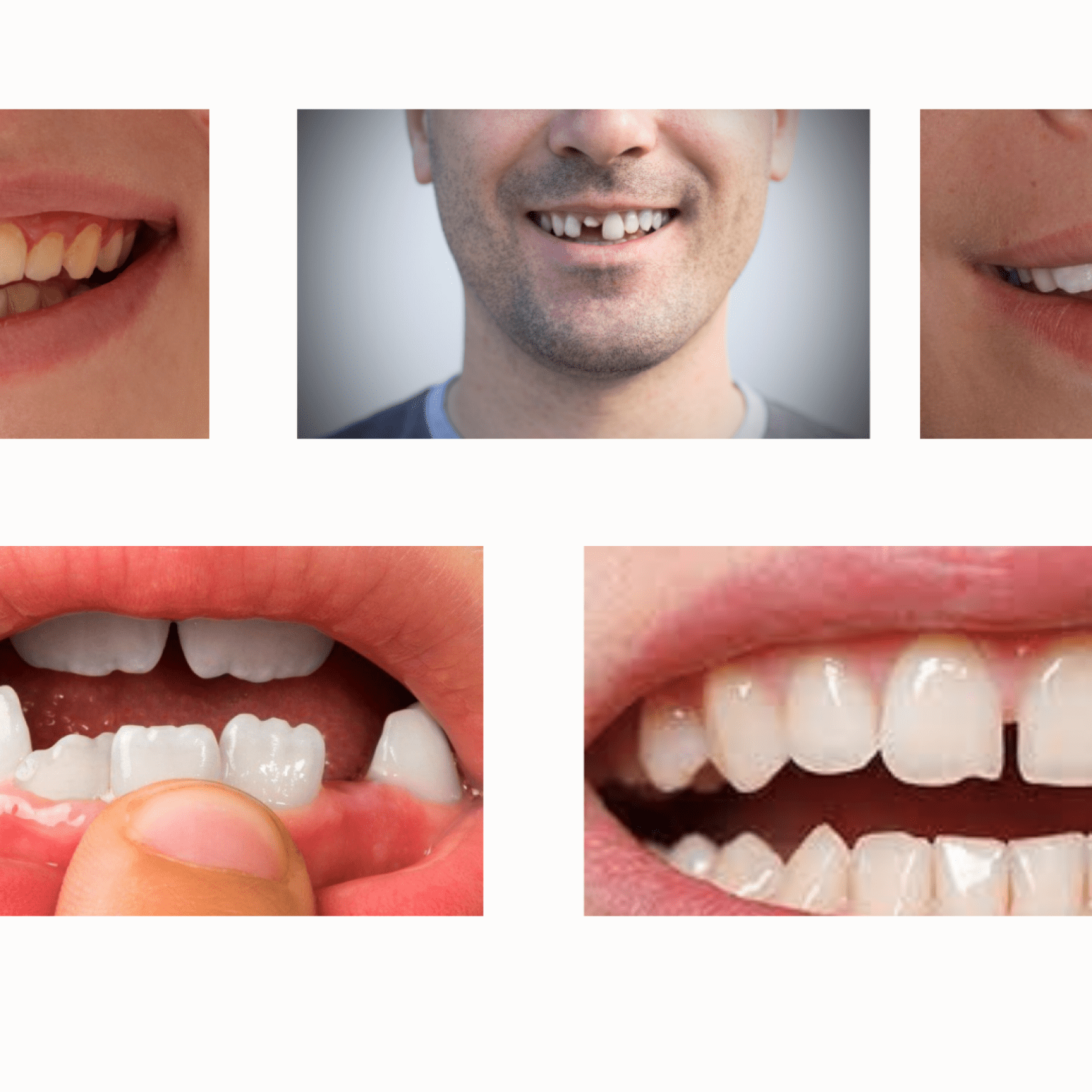 Dental Veneers: The Gateway To A Smile Makeover