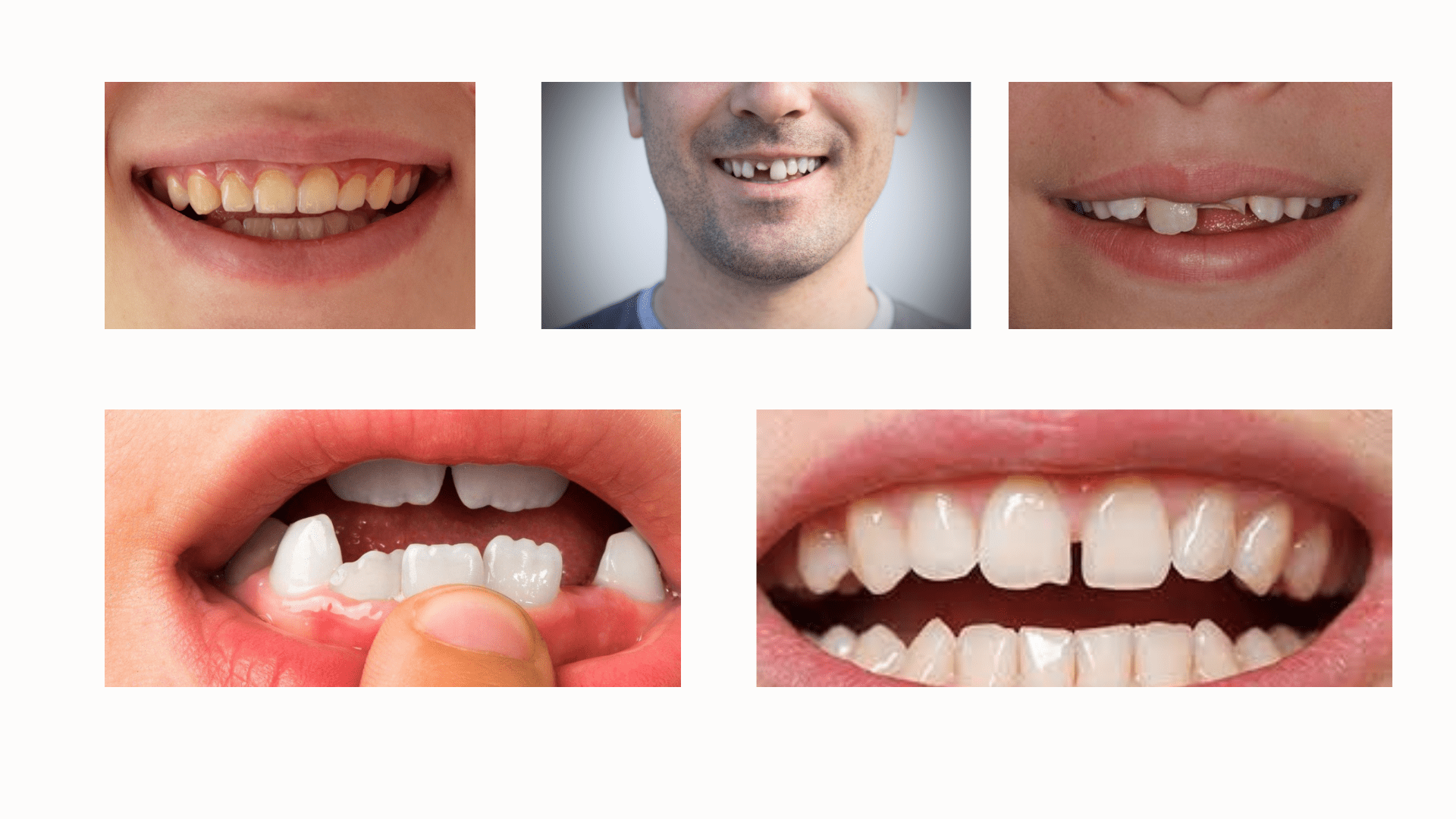 Porcelain or Composite Veneers