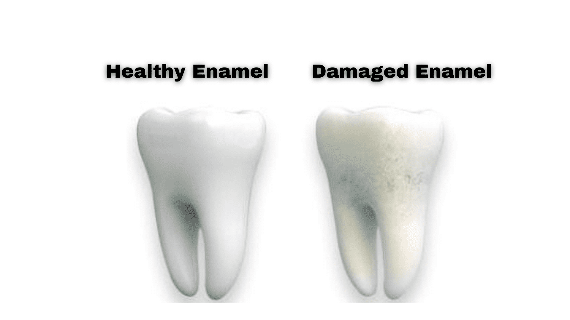 What is Enamel Erosion