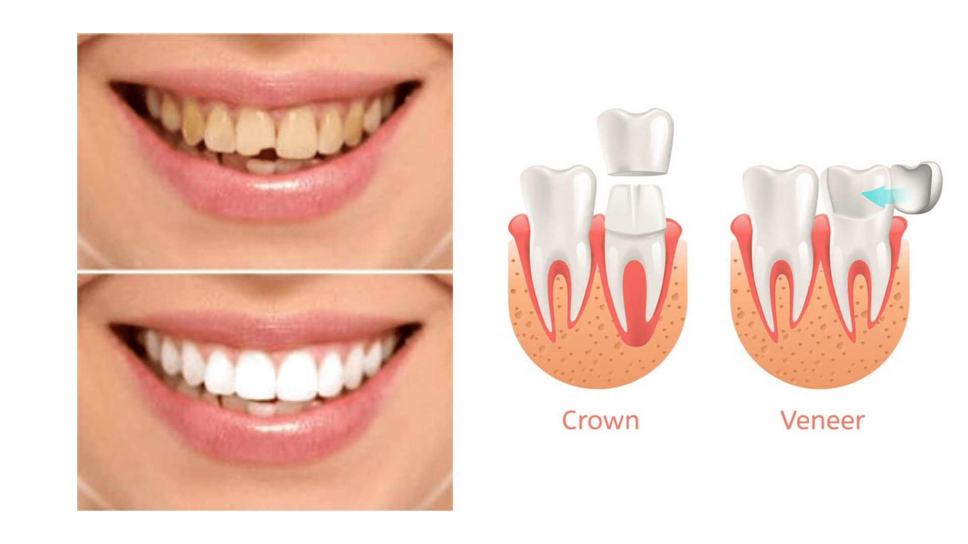 crown veneer