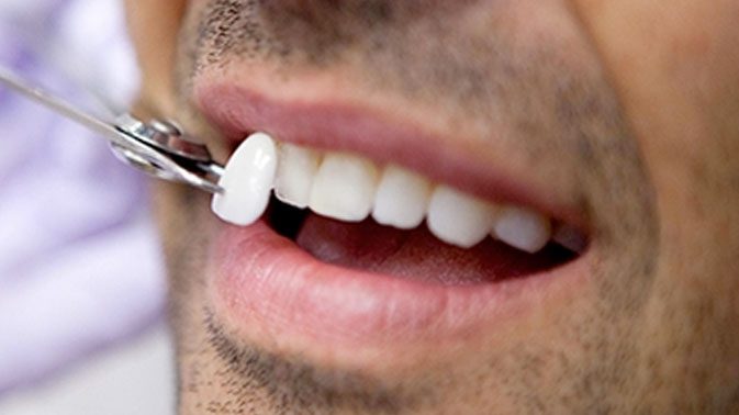 porcelain-veneers