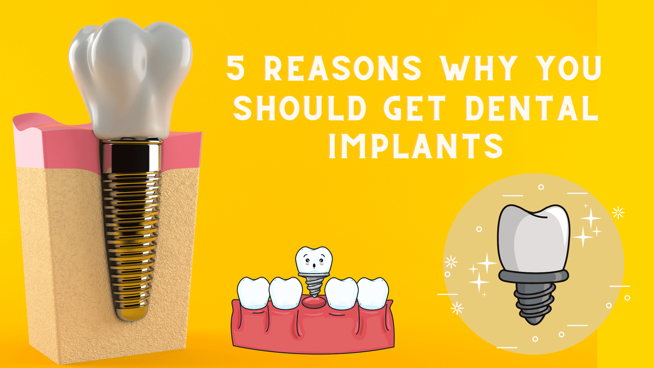 You are currently viewing 5 Reasons Why You Should Get Dental Implants