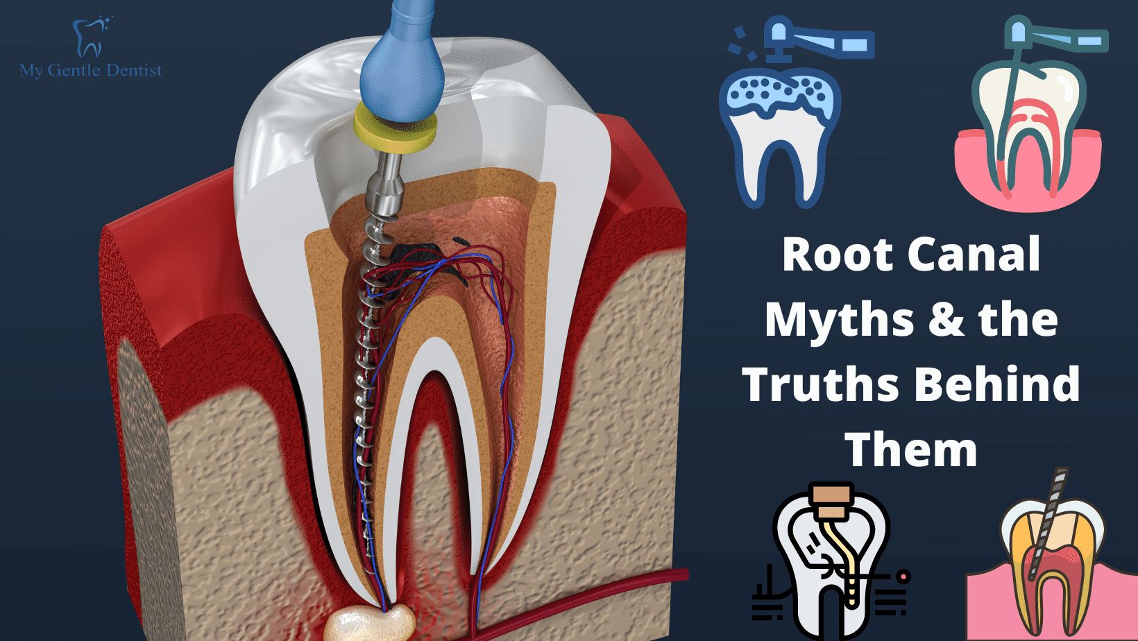 7 Root Canal Myths and the Truths Behind Them