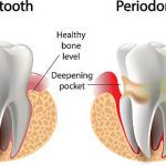 Read more about the article Signs and Symptoms of Periodontal Disease: What to Look Out For