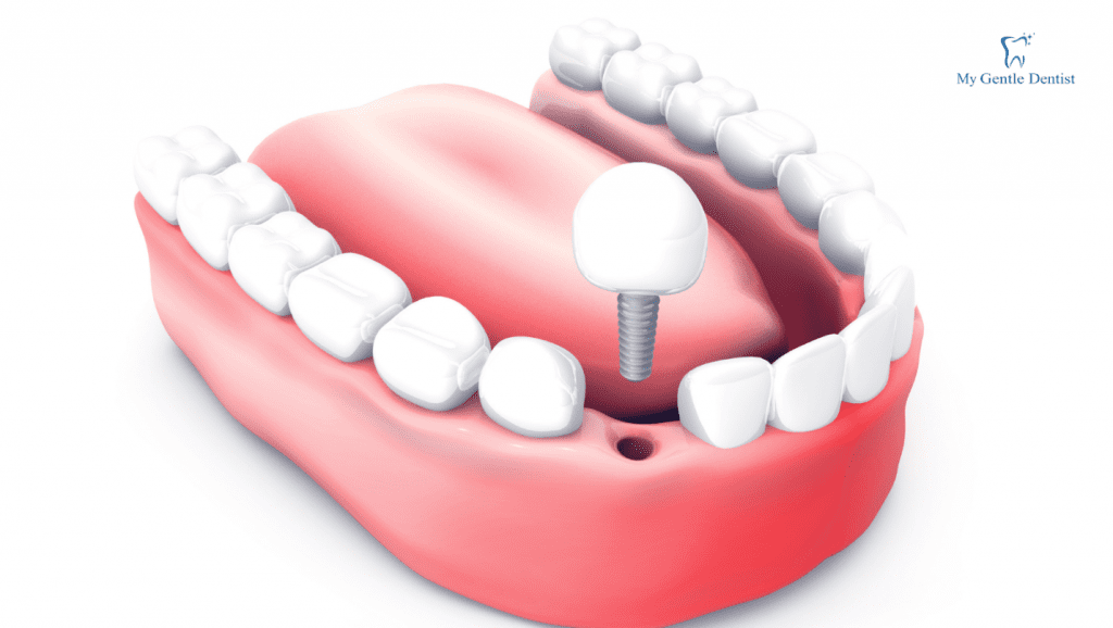 Dental implants are the best tooth-replacement option because they look and feel like your own teeth