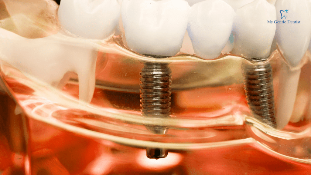 If you have very few teeth left, consider a dental implant-supported denture