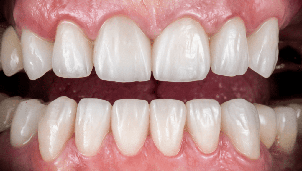 Veneers can be used on both the upper and lower teeth