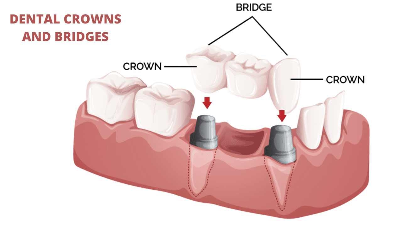 What are Dental Crowns and Bridges? Everything You Need to Know About