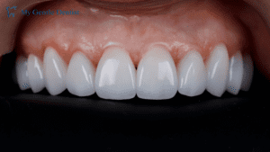 Read more about the article Dental Veneers Explained: Removal, Replacement Options, and Durability