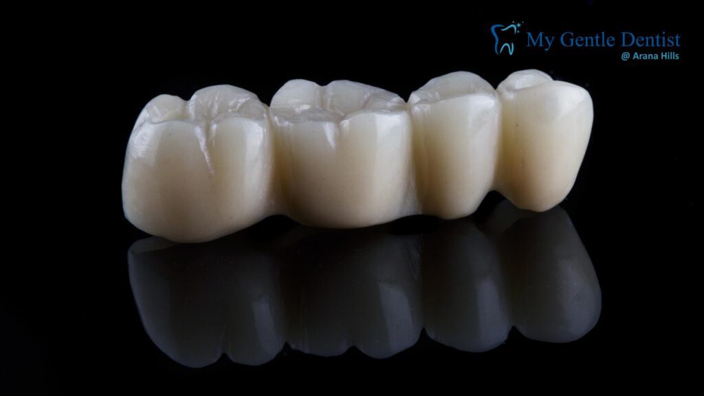Dental Bridges