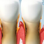 Read more about the article Non-Surgical vs Surgical Treatment for Gum Disease: What You Should Know