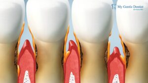 Read more about the article Non-Surgical vs Surgical Treatment for Gum Disease: What You Should Know