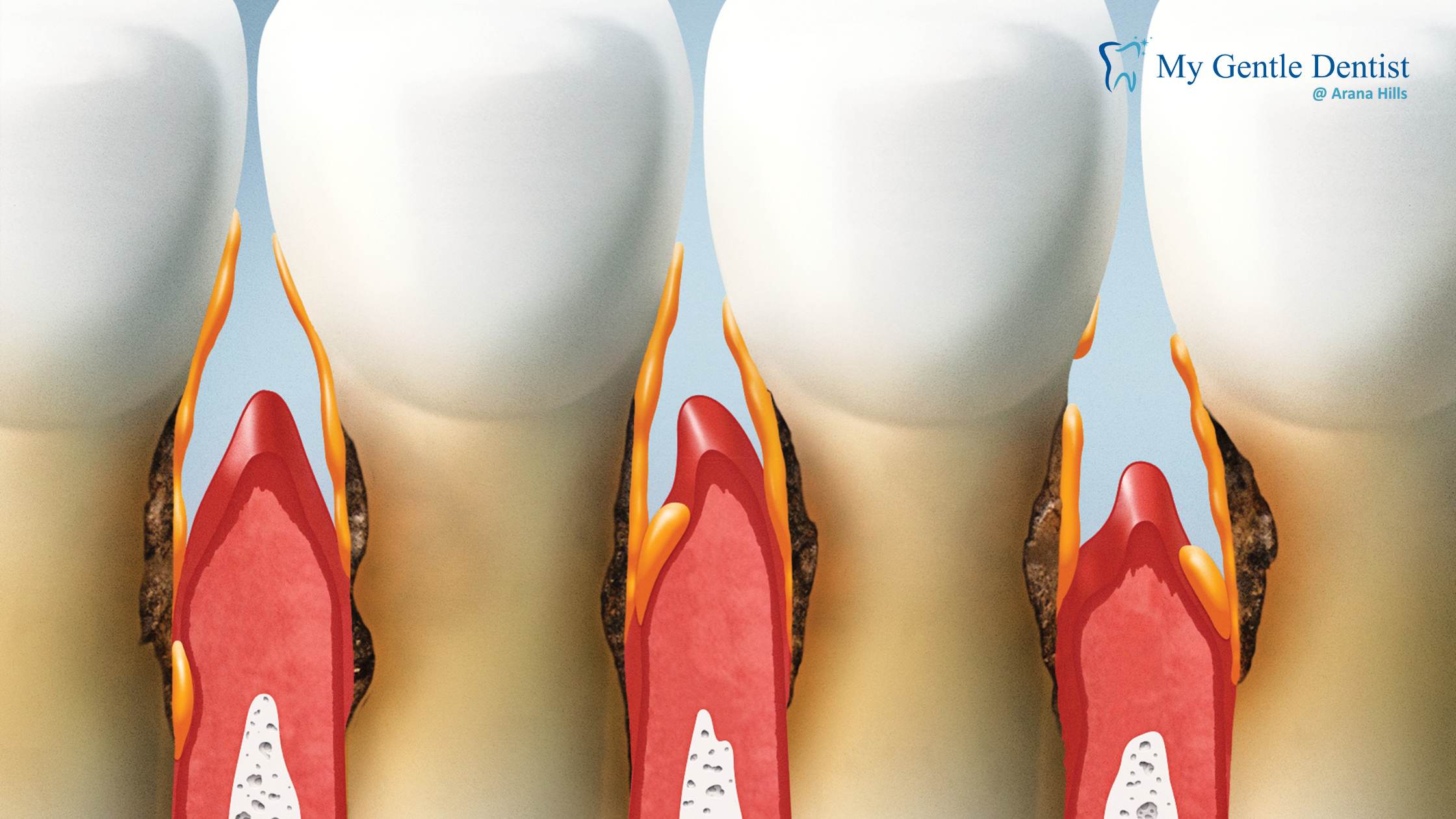 You are currently viewing Non-Surgical vs Surgical Treatment for Gum Disease: What You Should Know