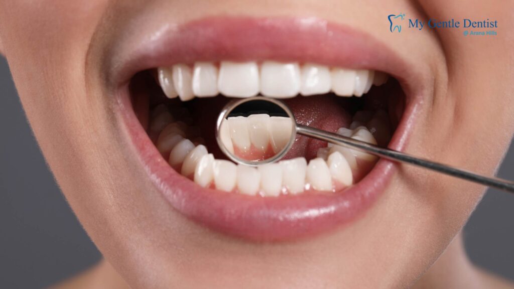 What Is Gum Disease
