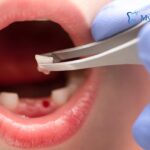 Read more about the article What Emergency Dentists Do When a Tooth Gets Knocked Out