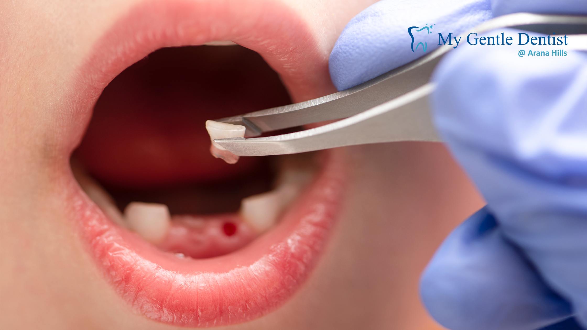 You are currently viewing What Emergency Dentists Do When a Tooth Gets Knocked Out