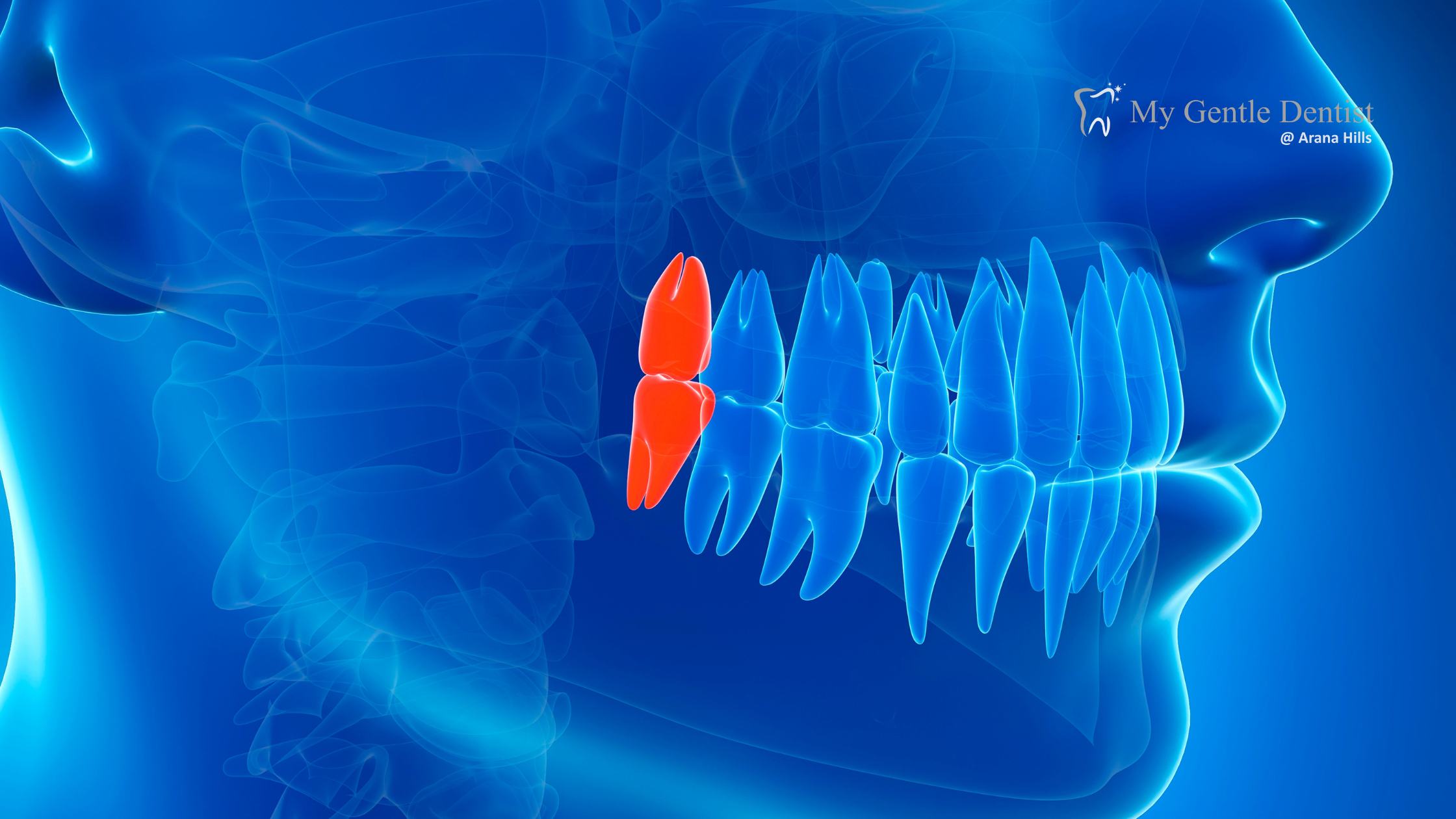 You are currently viewing Understanding Wisdom Teeth Removal Cost with or Without Sedation