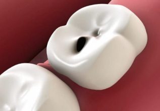 0006_Karies-768×480-1.jpg Damage teeth
