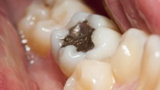 Amalgam Treatment