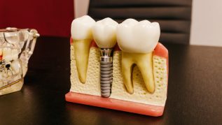 dental implant procedure